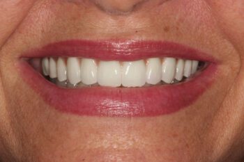 After re-restoration of implants and teeth