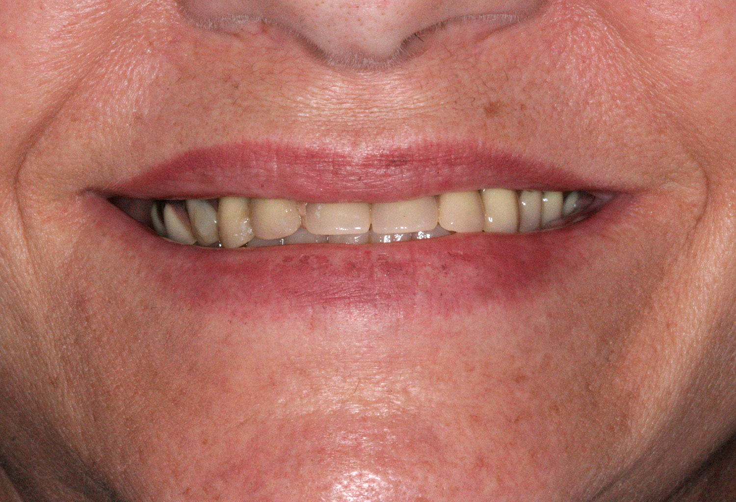 Before re-restoration of implants and teeth