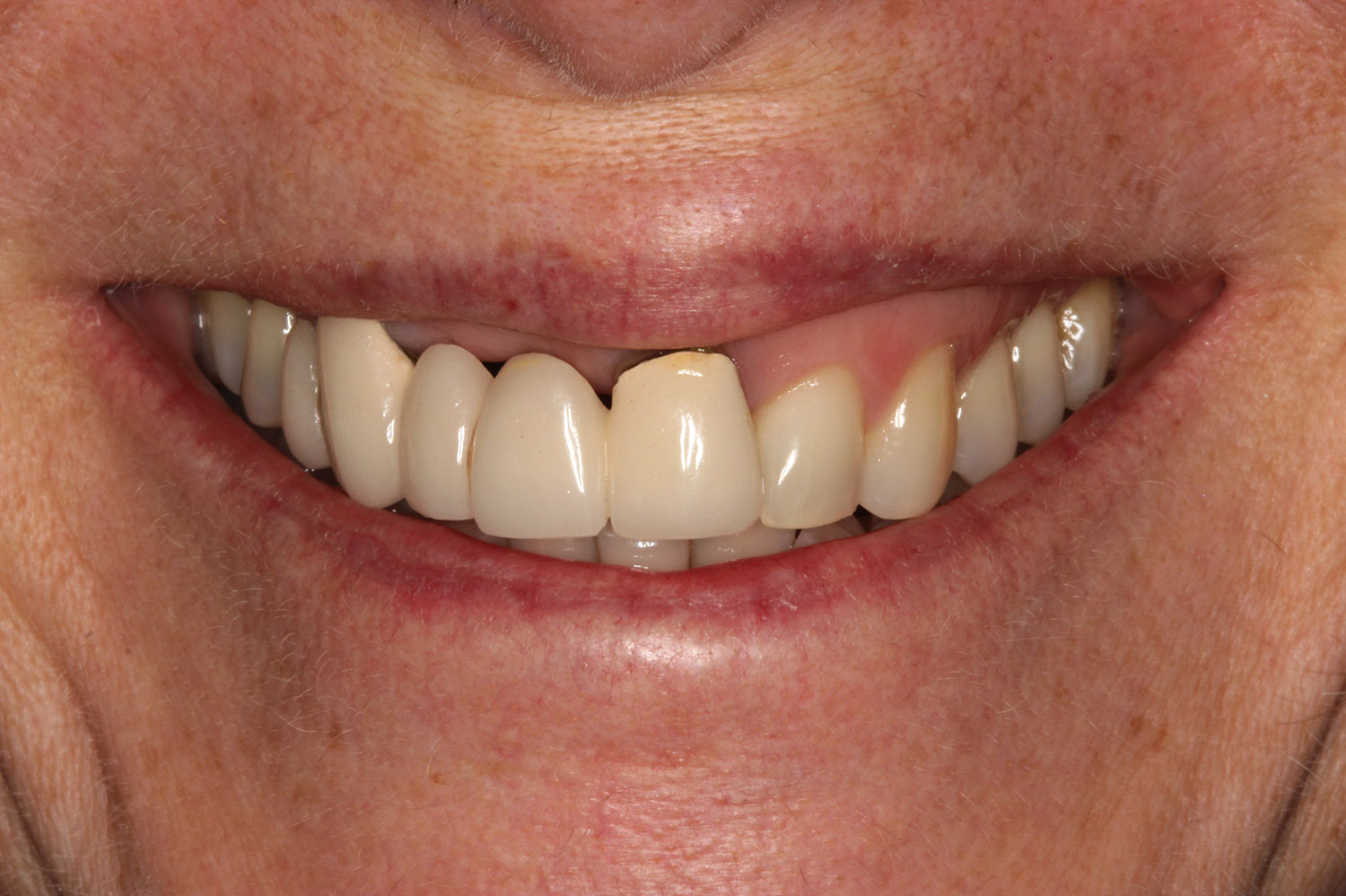 Before applying orthodontics and restoration