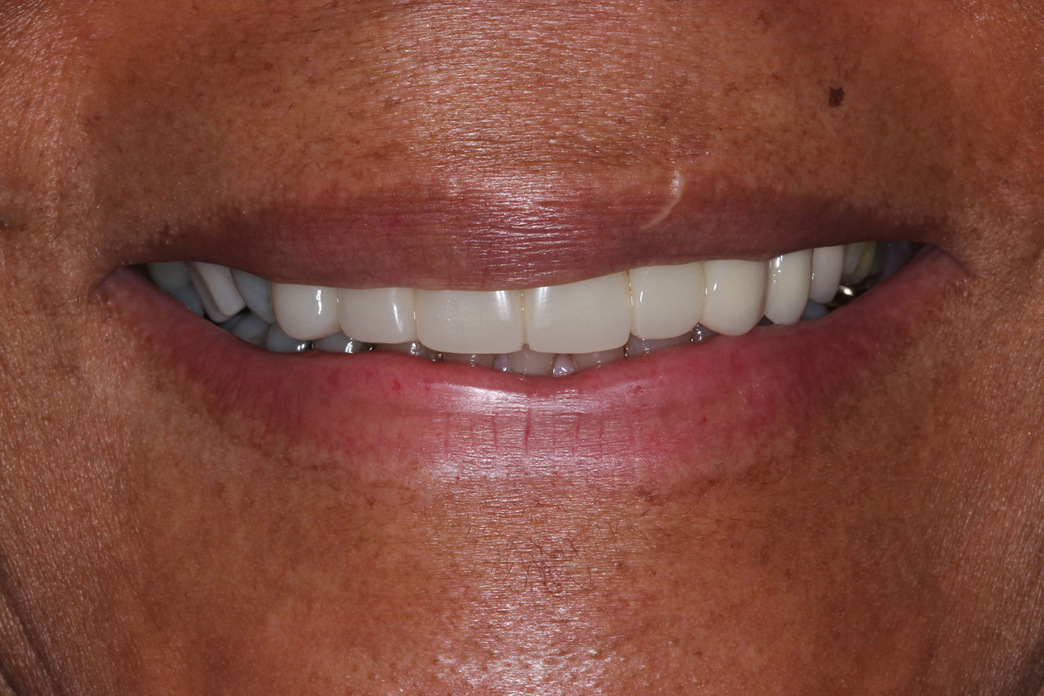 Teeth with applied orthodontics