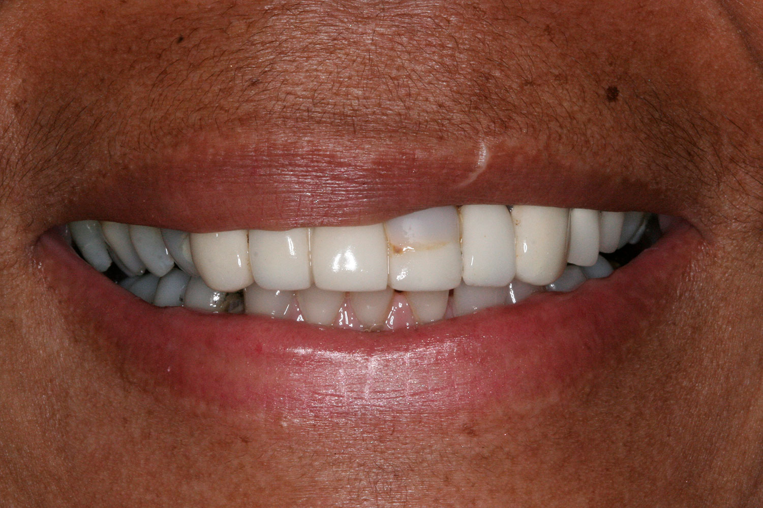 Teeth needing orthodontics