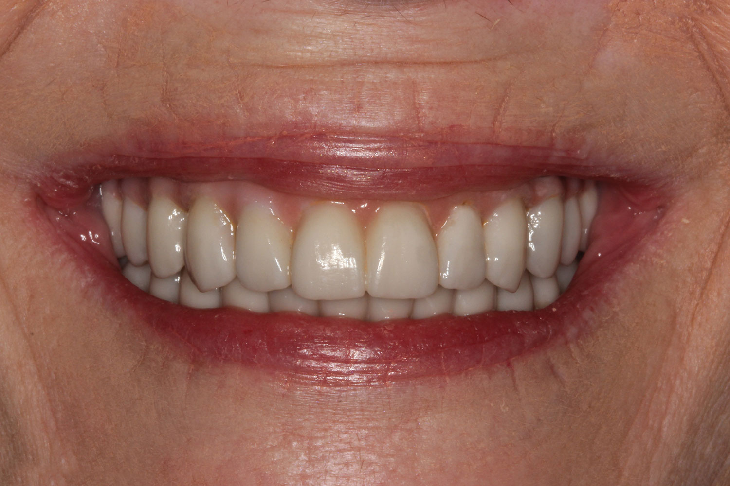 Restored implant and teeth
