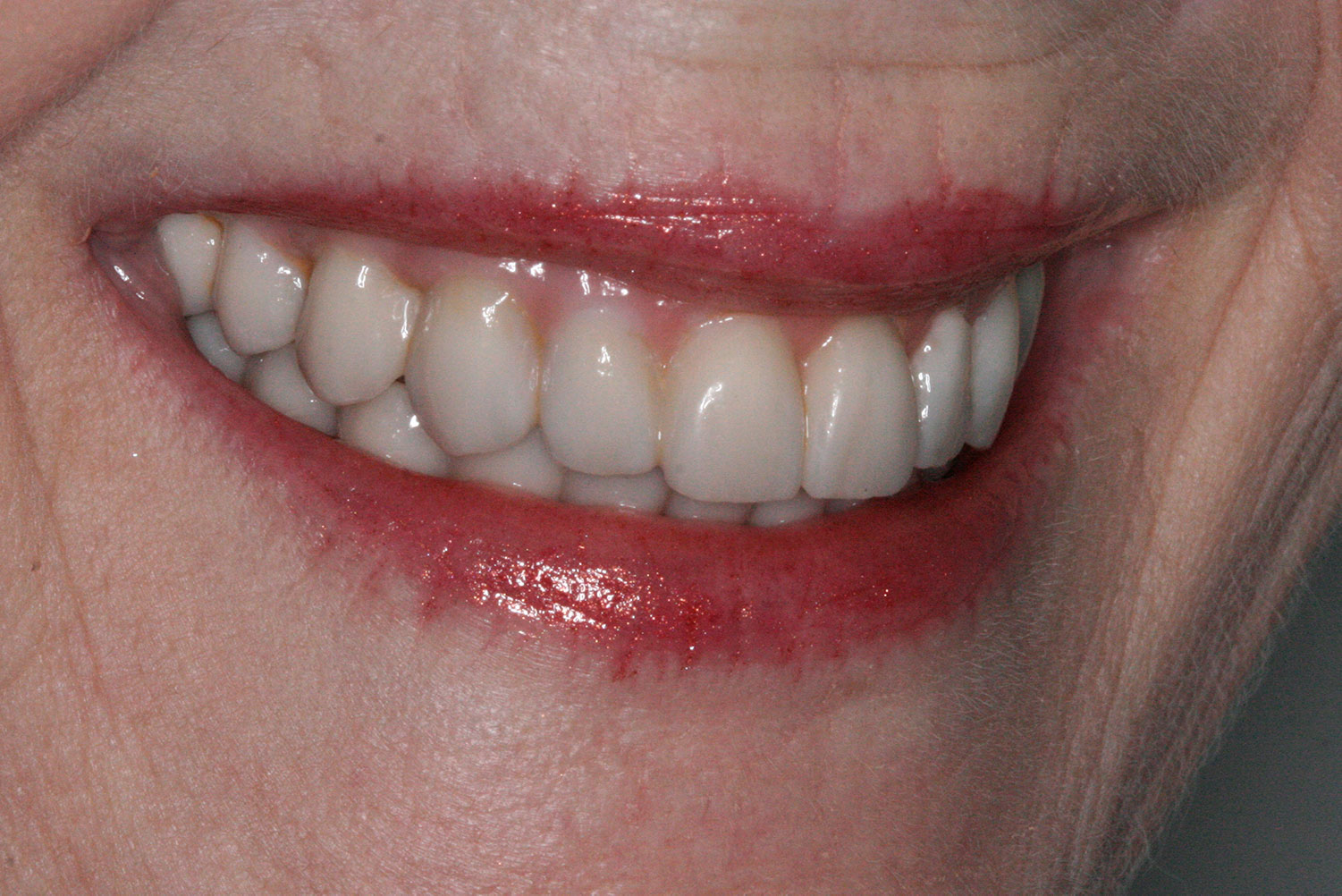 A partially side view of restored implant and teeth