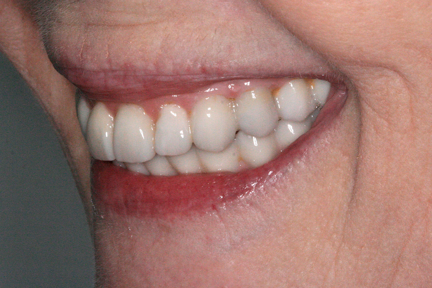 A side view of the restored implant and teeth