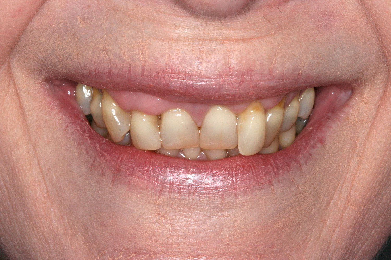 Teeth that need implant rehabilitations