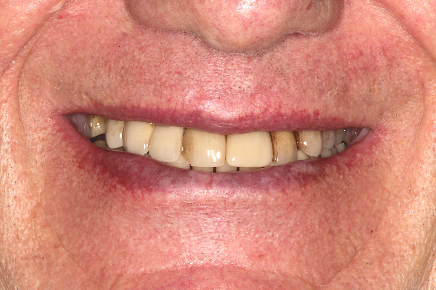Restoring yellowish teeth