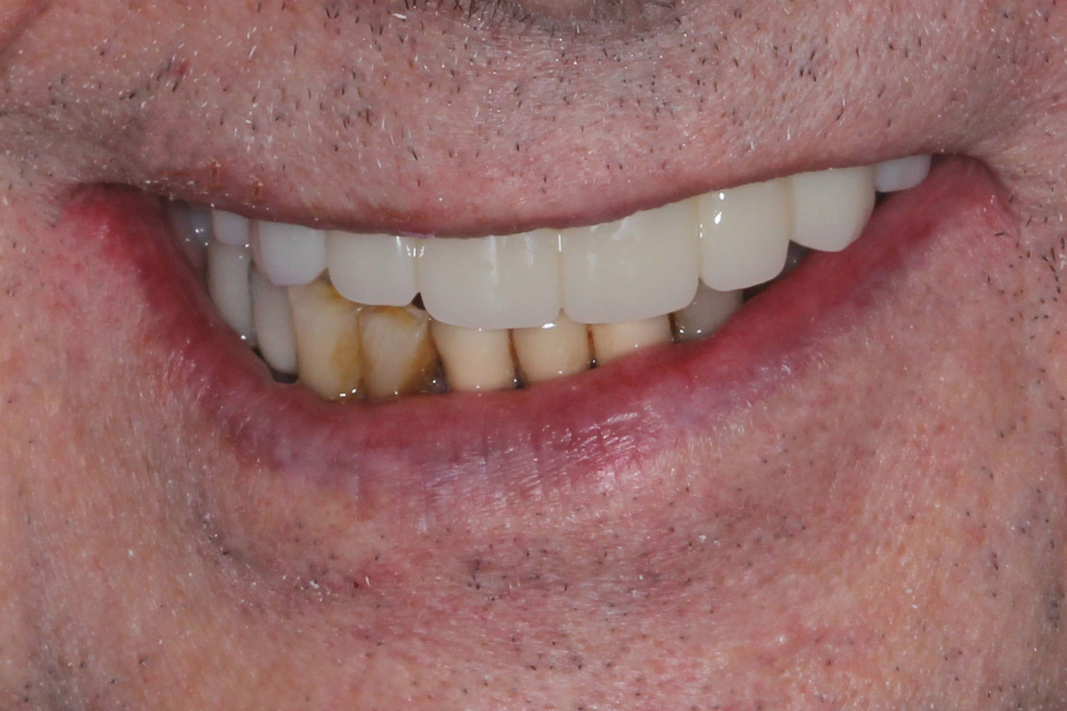 Restored implants for the teeth