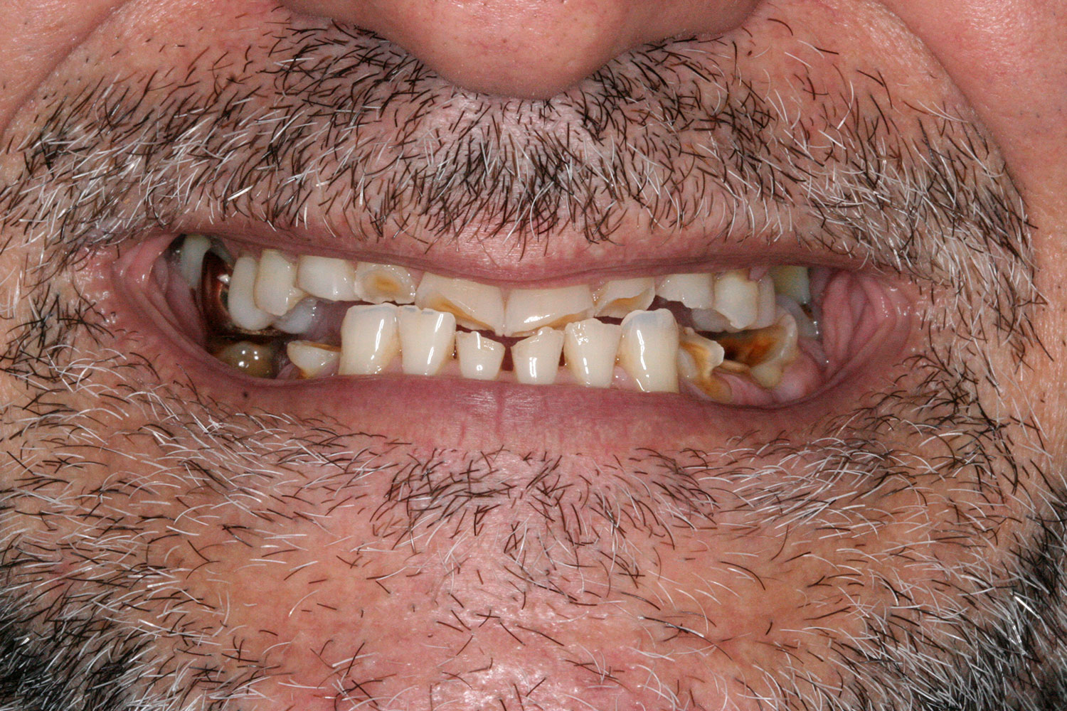 Teeth needing to restore ceramic implants