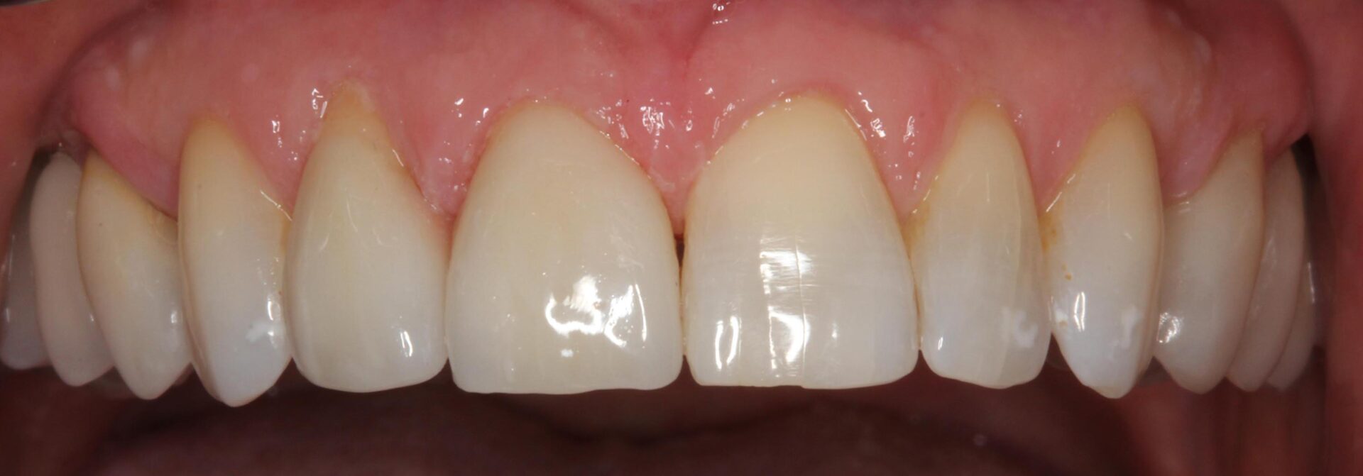 Tooth and crown ceramic restorations