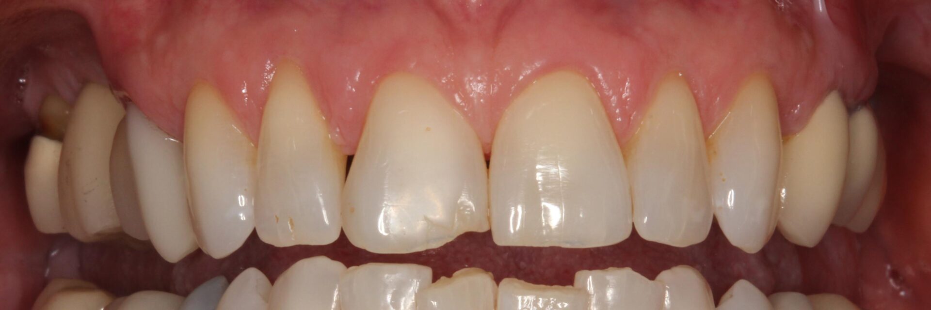 Teeth that needs crown restorations