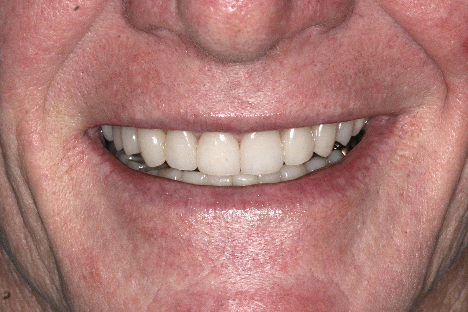 After adding crowns onlays and veneers