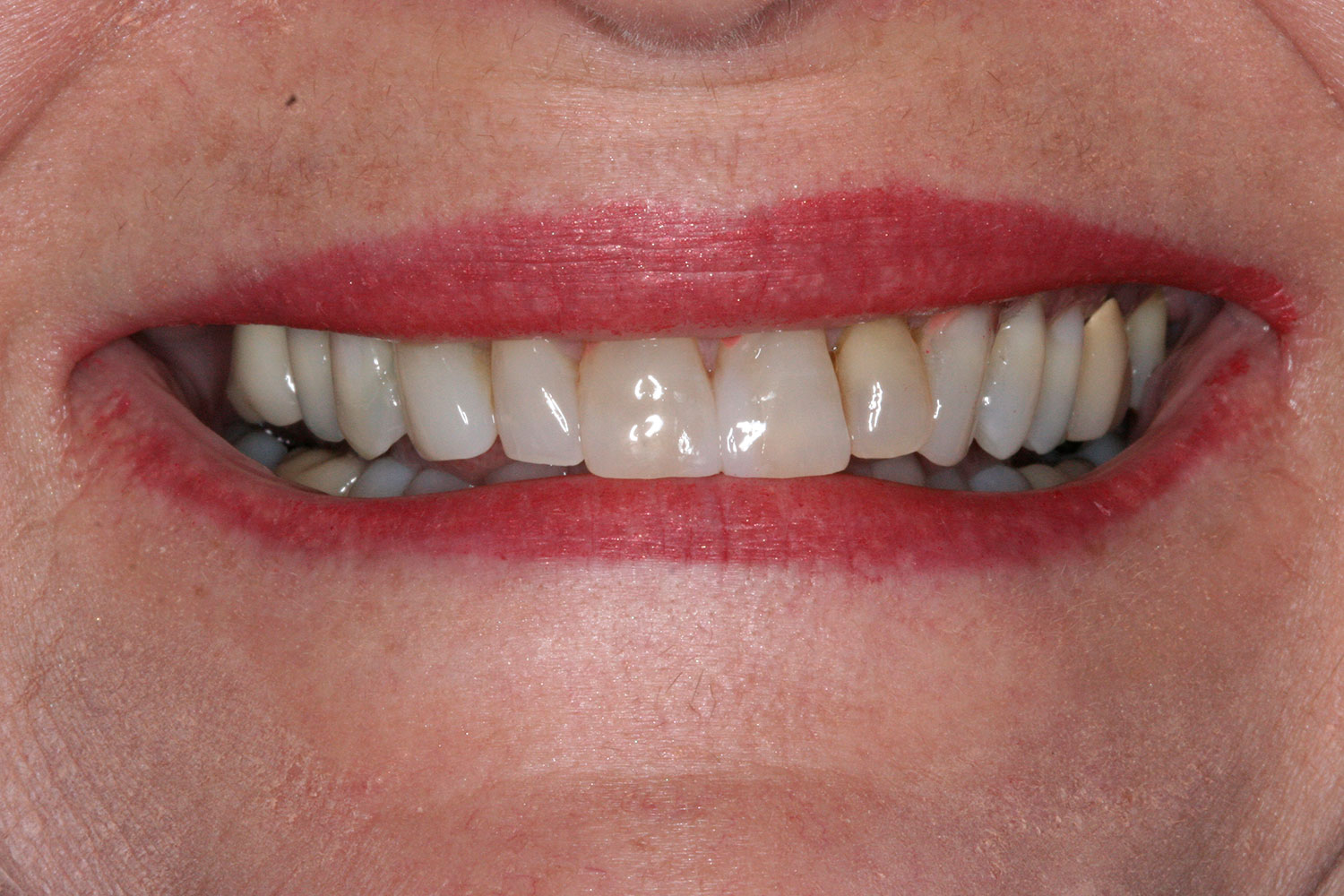 After reshaping teeth