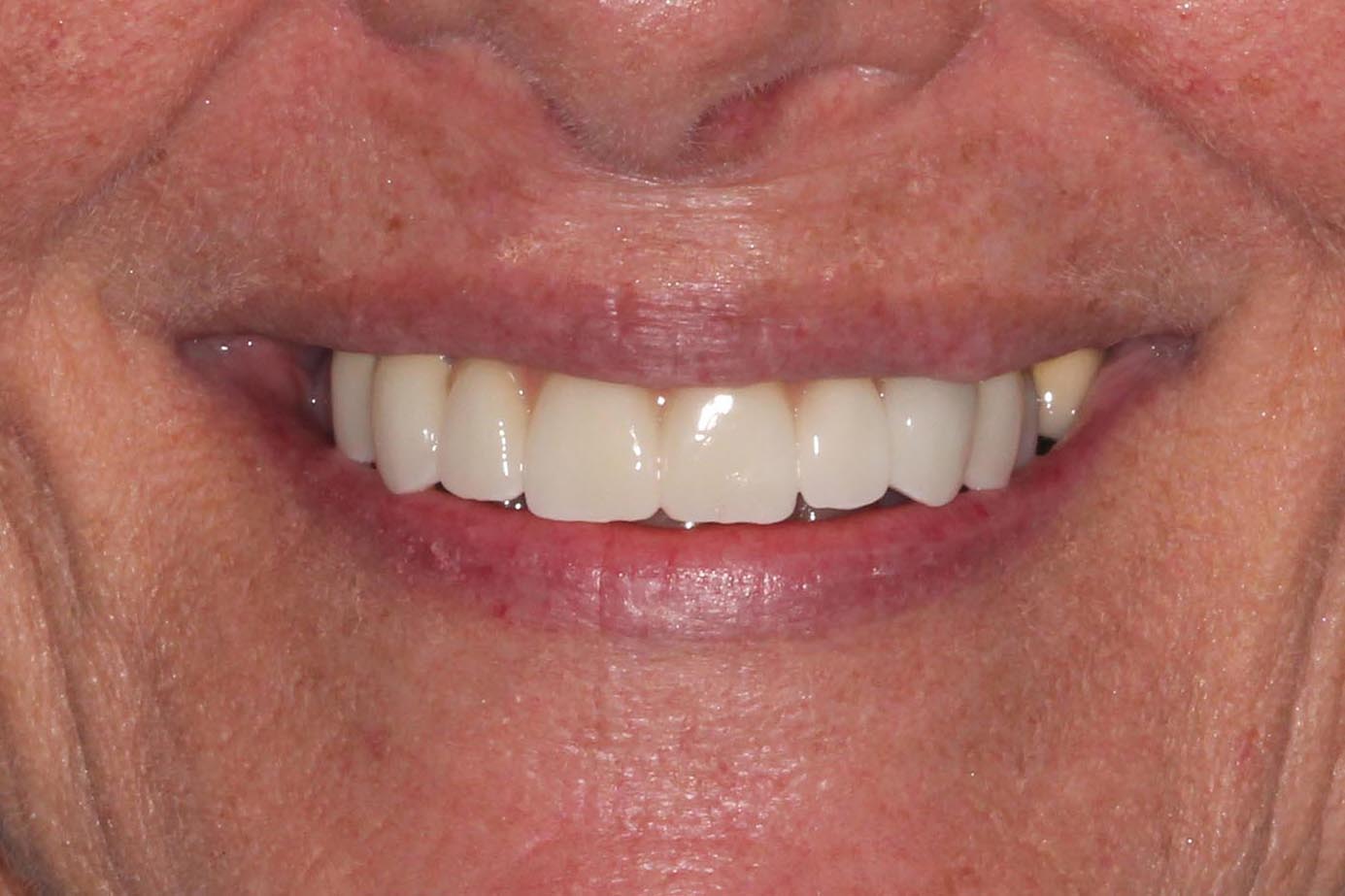Applied limited care, esthetics to teeth