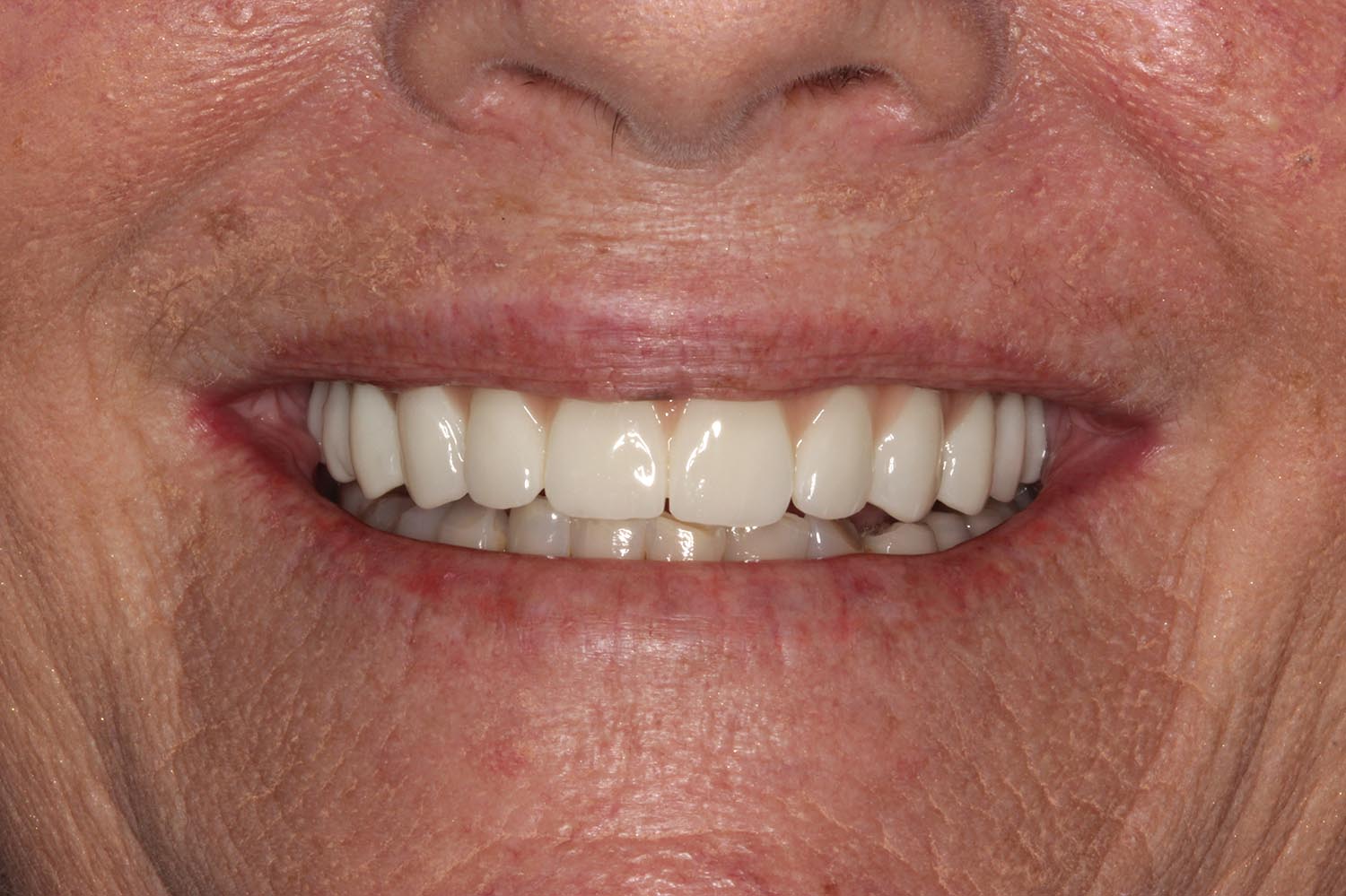 After adding limited implants and restorations