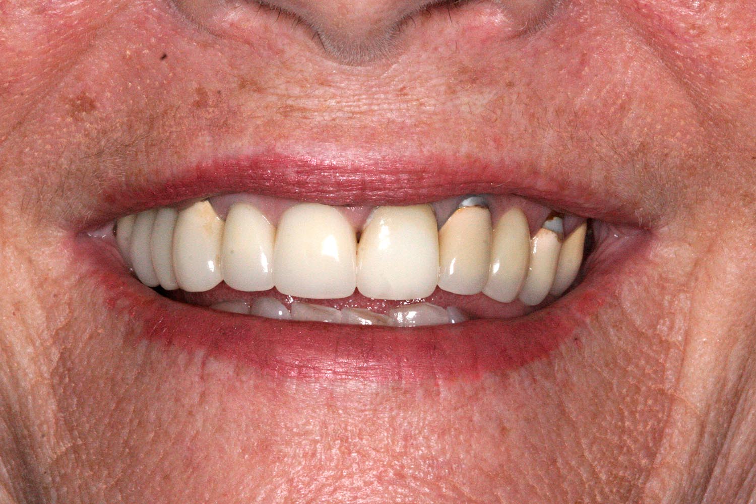 Before adding limited implants and restorations