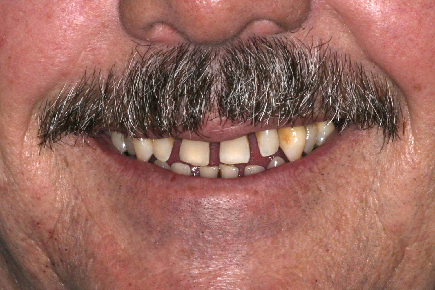 A set of teeth for a mixed full mouth rehabilitation