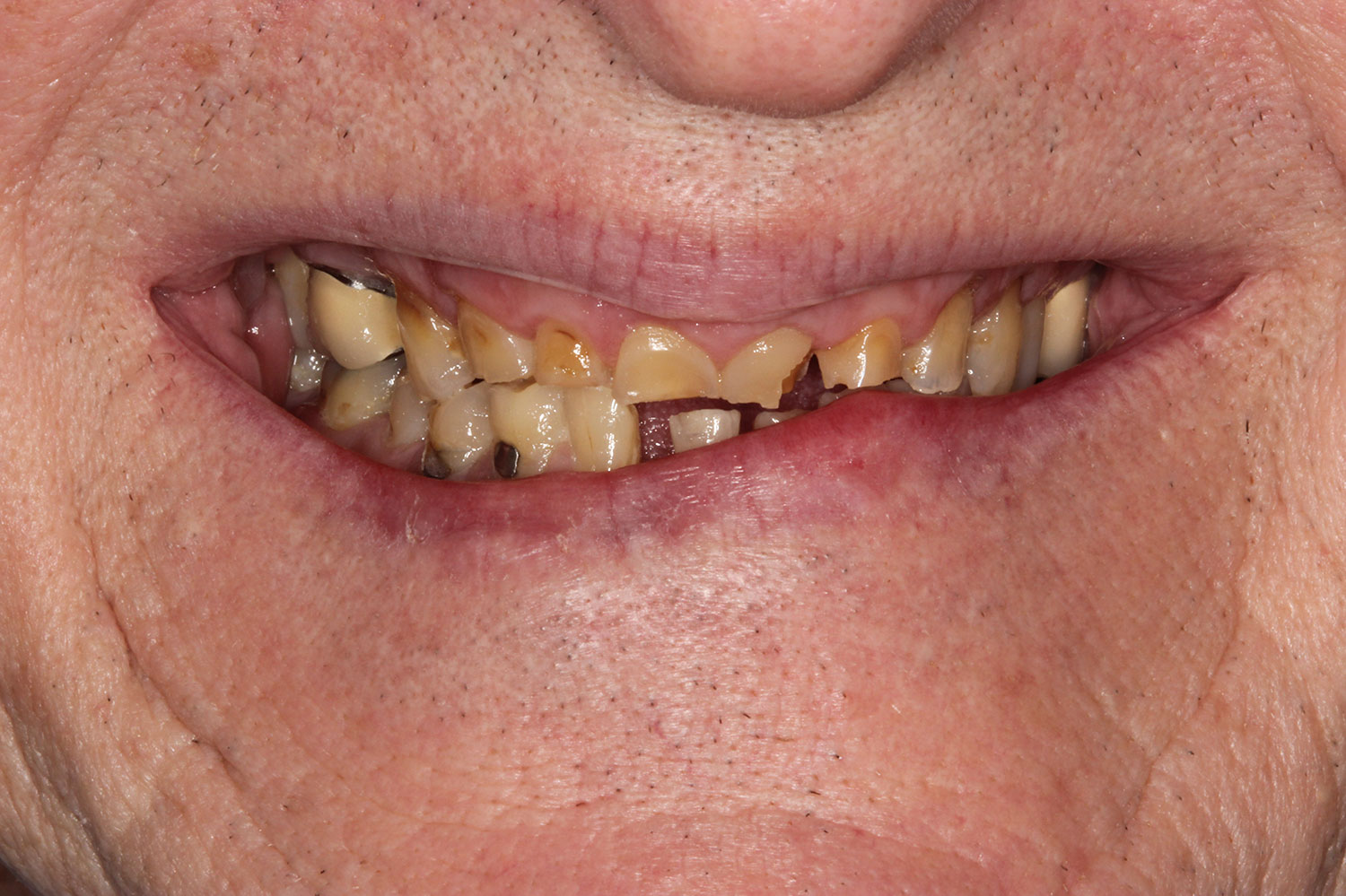 Teeth needing ceramic restorations