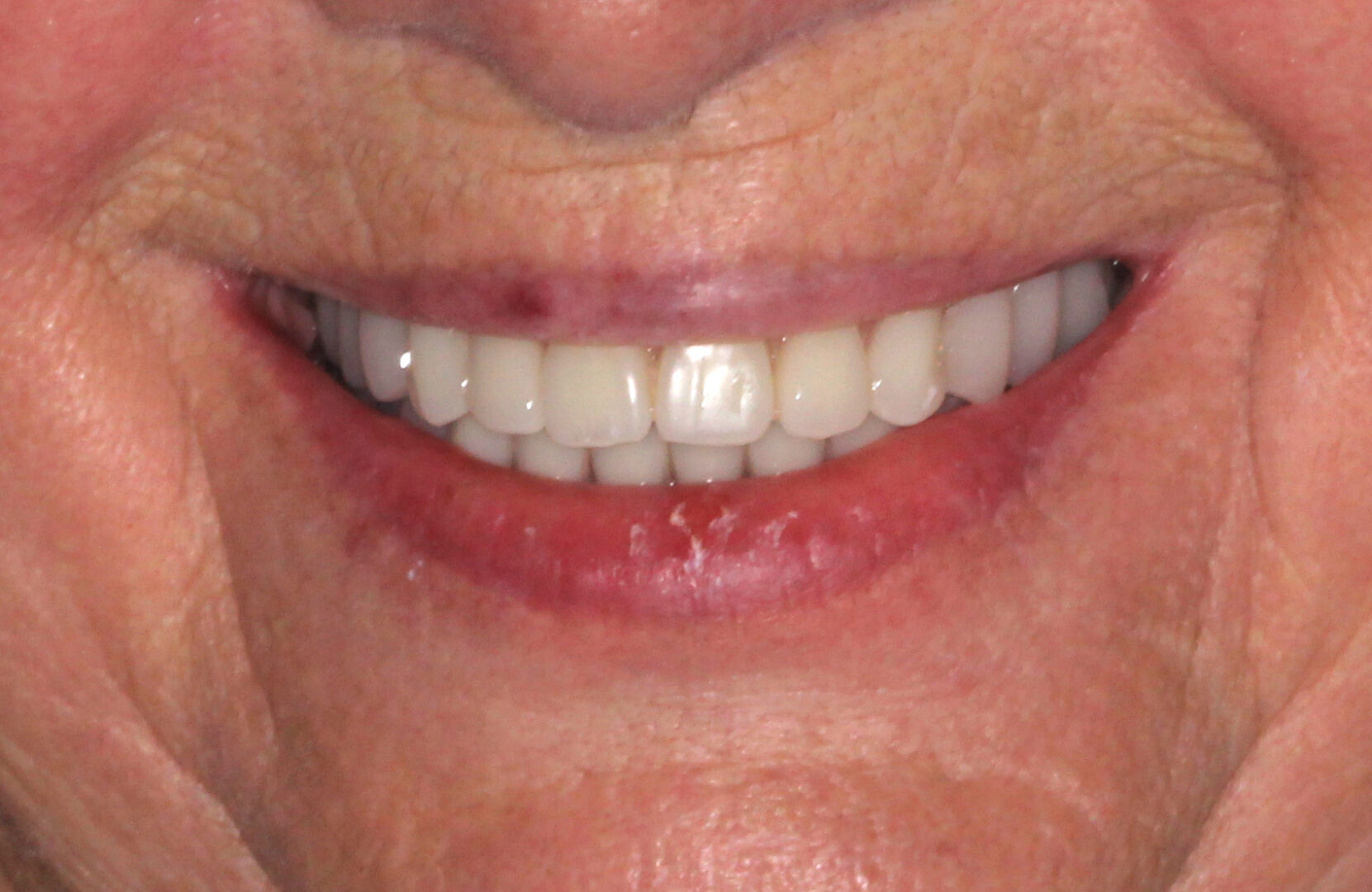 After applying restorations and dentures