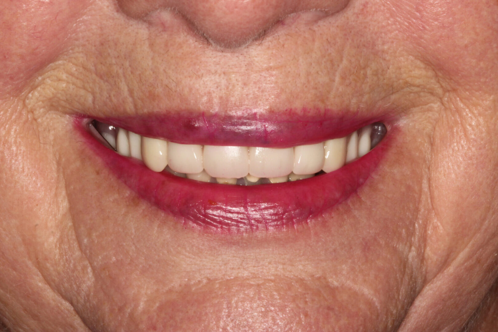 Teeth needing restorations and dentures