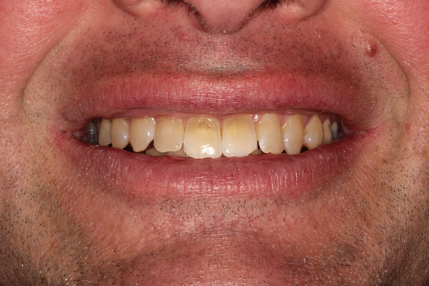 Teeth needing full restorations