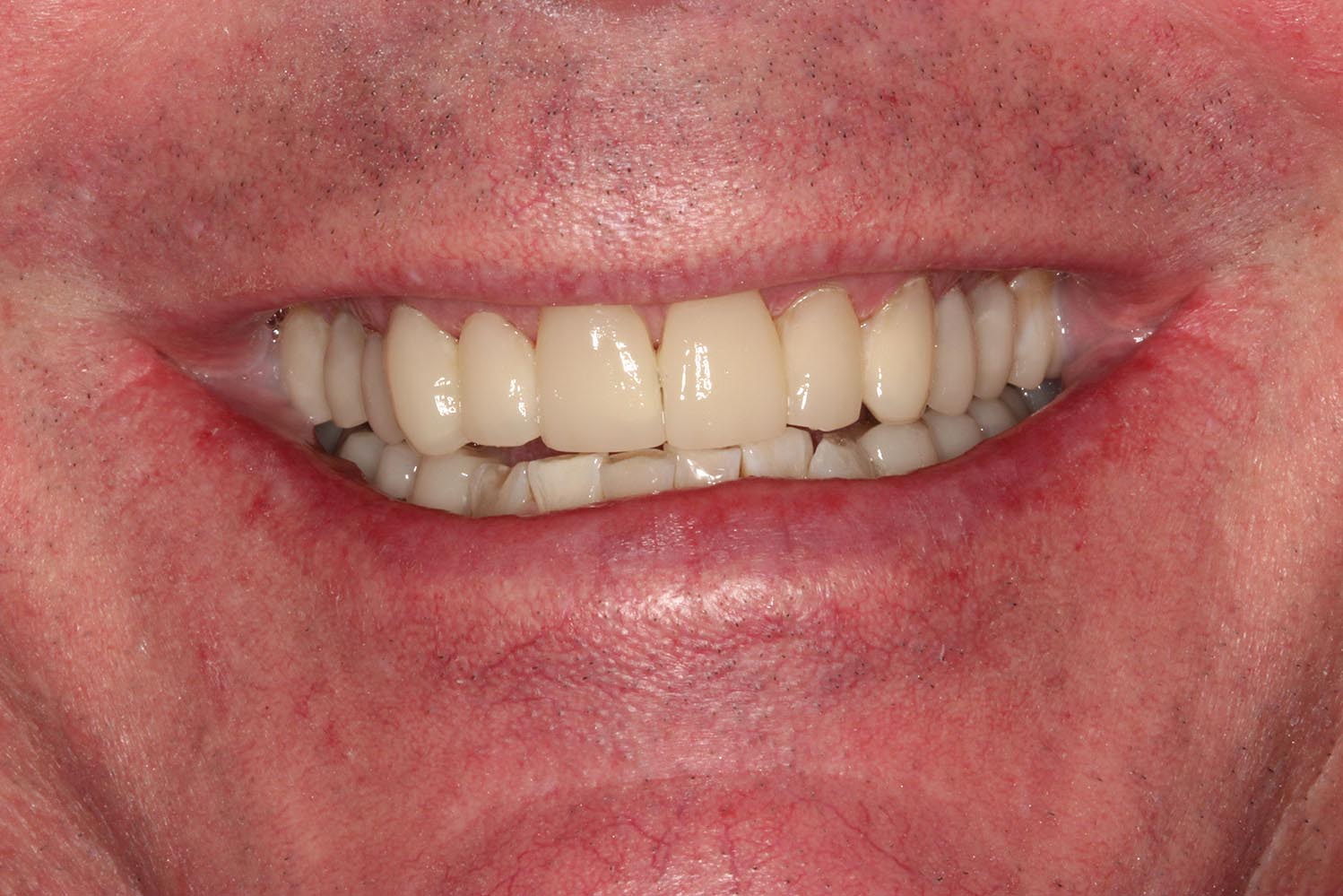 Partially restored teeth and orthodontics