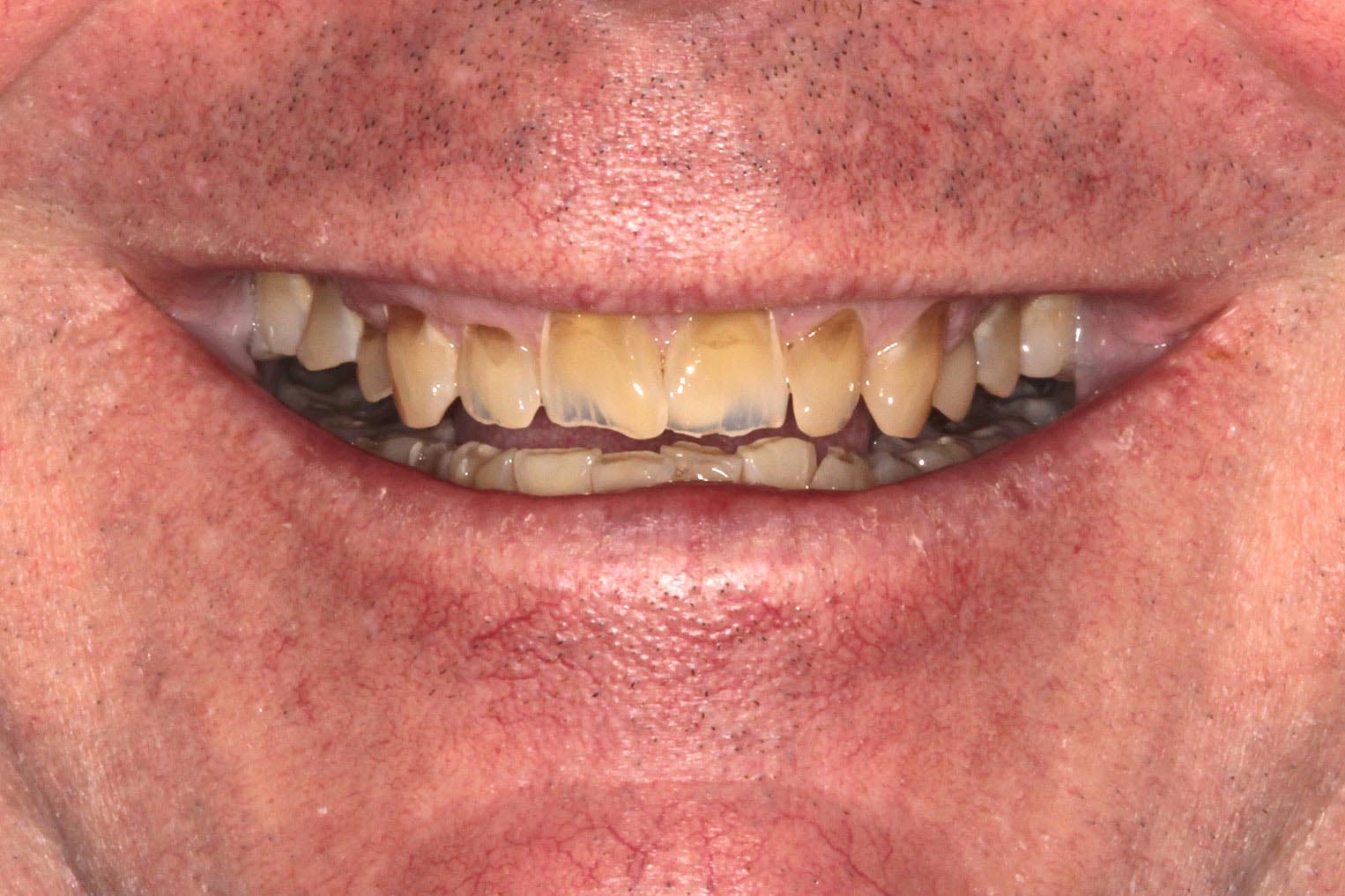 Teeth needing full restorations and orthodontics